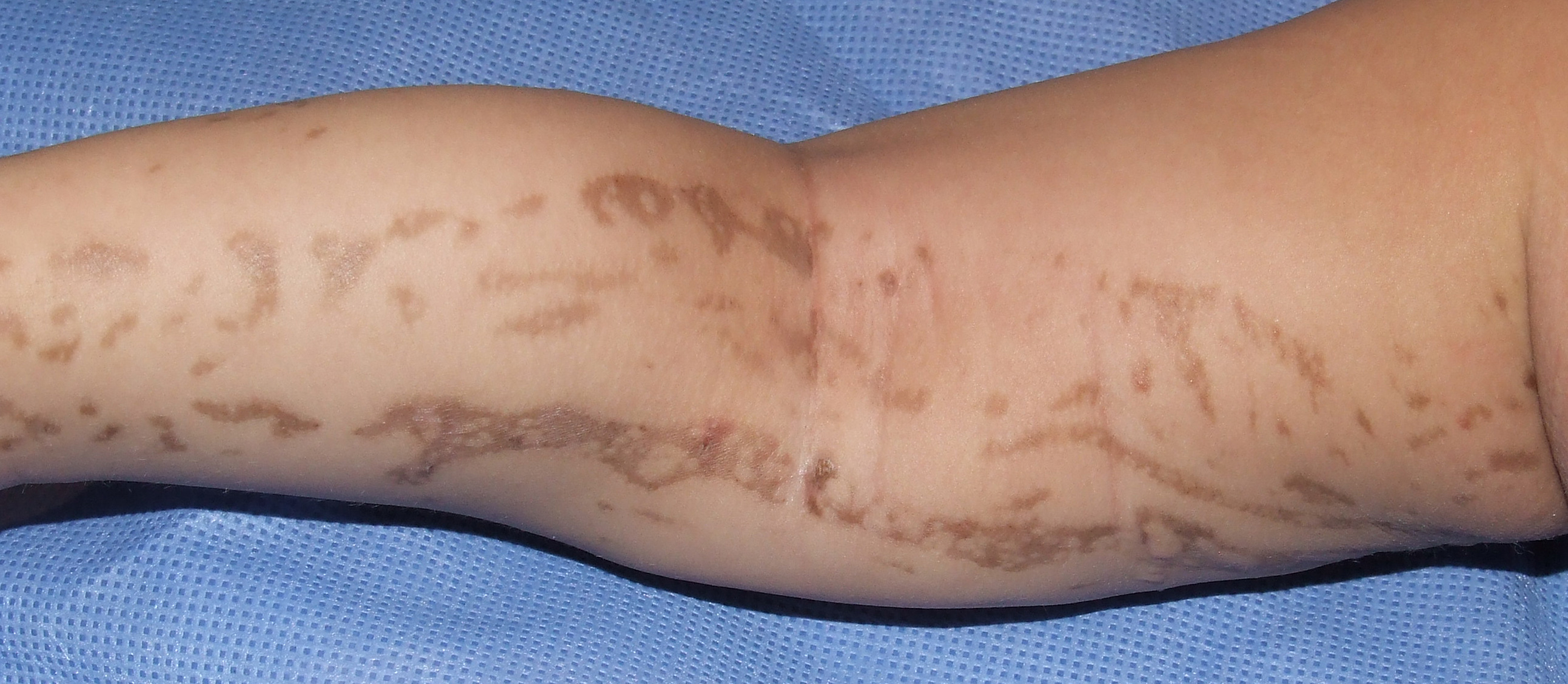 Incontinentia Pigmenti