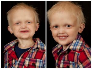 young boy with XLHED sowing a before photo and after with dentures. Oran has blonder hair and is wearing a red and navy check shirt and sat in front of a black back drop