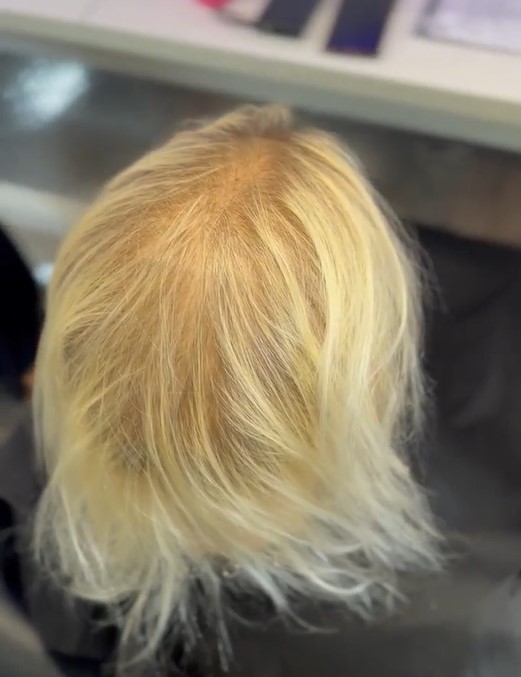 top of jayes head showing how thin and sparse her hair is