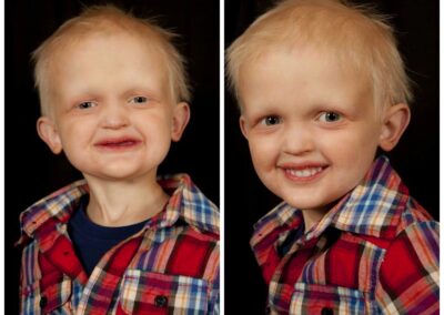 ED boy before and after images of being fitted with dentures